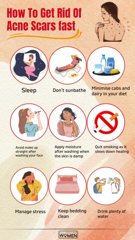 How To Get Rid Of Acne Scars Fast🌸 #acne #pimples #pimplesremedies #acneremedies #skincarediy. https://whispers-in-the-wind.com/combatting-pimples-under-the-skin-expert-tips-and-product-recommendations/?105 Getting Rid Of Scars, Face Mapping Acne, Blind Pimple, Stubborn Acne, Pimples Under The Skin, Acne Prone Skin Care, Acne Overnight, Pimples Overnight, Get Rid Of Acne