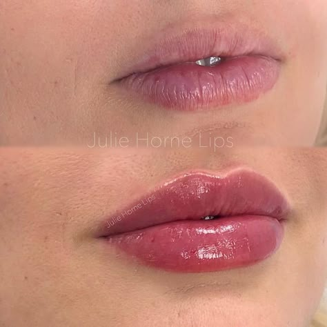 Best of Cosmetic Dermatology on Instagram: “Natural pout and crisp border with 1 ml Restylane Kysse 💉💋 Thoughts? . . Impressive work by @juliehornelips 🙌🙌 . . #Filler #fillers…” 1.5 Lip Filler, Vermillion Border Lip Filler, Lip Filler 1 Ml, Lip Filler Natural Look, Lip Filler Before And After 1ml, Pout Lip Filler, Natural Lip Fillers 1ml, .5 Lip Filler, Natural Lip Fillers 0.5ml