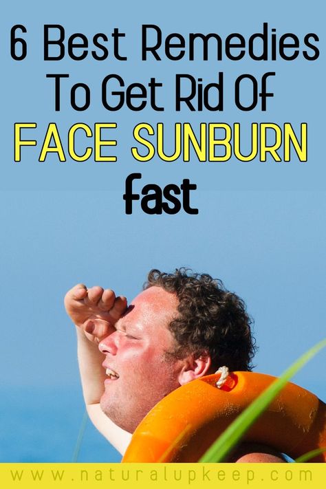 Sunburn especially face sunburn can be very painful and inconvenient. Here are the best remedies that will give you instant relief like magic. The remedies are highly recommended for sunburn not just from me but by many people on the internet. Click to find out how to get instant sunburn relief which will prevent peeling too. #sunburninstantrelief #sunburnnaturalremedy #howtogetridofsunburn #facesunburnremedy Face Sunburn Remedies, Sunburn Remedies For Face, Sunburn On Face, Sunburnt Face, Face Dry Skin, Face Redness, Get Rid Of Sunburn, Sunburn Peeling, Face Peeling