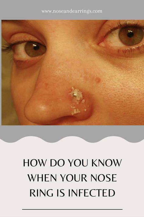 How Do You Know When Your Nose Ring Is Infected Infected Nose Ring, Nose Ring Bump, Infected Nose Piercing, Nose Piercing Infection, Nose Piercing Bump, Piercing Bump, 8th Sign, Shape Of You, Nose Piercing