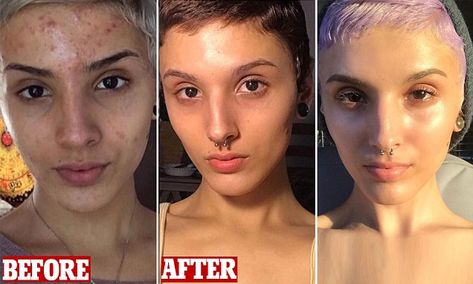 Woman shares before-and-after transformation of her skin Tretinoin Before And After, Before And After Acne, Acne Women, Apple Cider Vinegar Acne, Get Rid Of Acne, Rid Of Acne, Types Of Acne, How To Get Rid Of Acne, Acne Skin