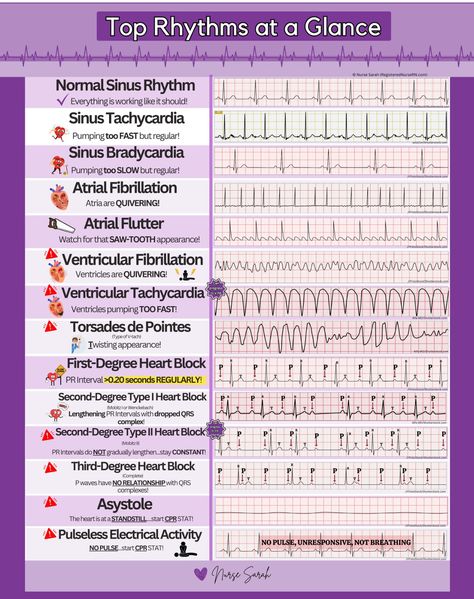 Cardiac Rhythms Ekg Interpretation, Ekg Arrythmias, Cardiac Dysrhythmias Nursing, Junctional Rhythm Ekg, Ekg For Dummies, Cardiac Monitor Tech, Cardiac Arrhythmias Nursing, Cardiac Diseases Nursing, Cardiac Meds Nursing