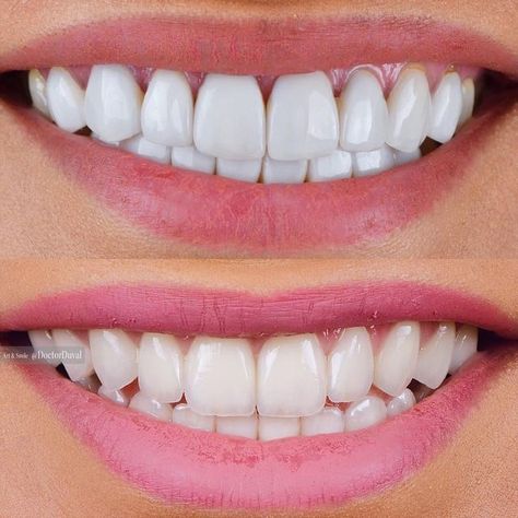 Teeth Transformation, Perfect Teeth Smile, Face Plastic Surgery, Loose Teeth, Aesthetic Smile, Pretty Teeth, Dental Posters, Bad Teeth, Beautiful Teeth