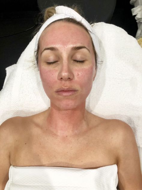 Benefits of micro-needling: What to expect during microneedling Glass Skin Before And After, Prp Microneedling Before And After, Micro Needling Benefits, Micro Needling Before And After, Microneedling Before And After, Microneedling Benefits, Skinpen Microneedling, Facial Before And After, Esthetician Business