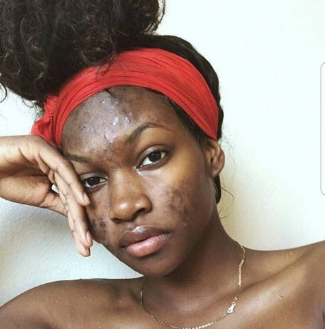 Be careful with me @ⓝⓨⓐⓡⓘⓔ ⓓ Girl With Acne, Acne Women, Lemon Face Mask, Bad Acne, Bare Beauty, Pretty Skin, Real Beauty, Be Careful, Brown Skin