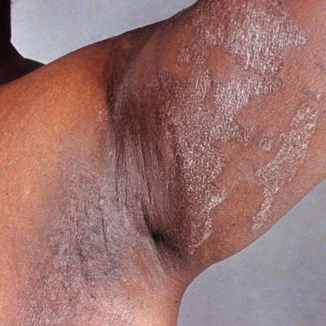 9 Common Skin Infections That Cause a Rash: Erythrasma Yeast Infection Pictures, Skin Rash Remedies, Home Remedies For Rashes, Yeast Infection On Skin, Clinic Poster, Fungal Infection Remedies, Fungal Infection Skin, Home Remedies For Skin, Fungal Infection