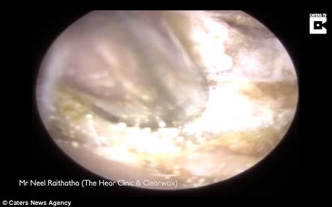 Woman left deaf by a huge chunk of earwax finally gets it removed Best Ear Wax Removal, Impacted Ear Wax, Sunburn Peeling, Swimmers Ear, Ear Wax Buildup, Natural Face Care, Dead Skin Removal, Ear Wax Removal, Superbowl Party Food