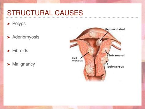 STRUCTURAL CAUSES ➤ Polyps ➤ Adenomyosis ➤ Fibroids ➤ Malignancy Polyps Uterus, Polycystic Ovarian Syndrome, Women's Health, Womens Health, Medical, For Free, Health