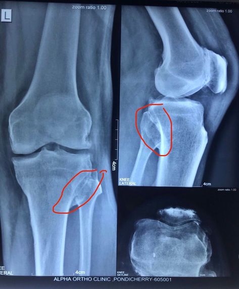 Heterotopic ossification in Knee x-ray Knee Injury Snapchat, Knee Xray, Leg Bandage Snapchat, Leg Bandage, Injection Hand Pic, Arte Ganesha, Sardar Fashion, Knee Operation, St Bus