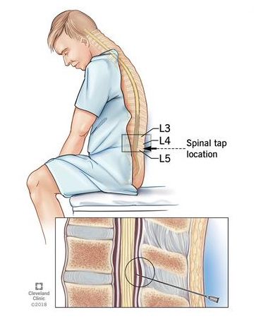 Spinal Tap, Throbbing Headache, Spinal Fluid, Cerebrospinal Fluid, Severe Headache, Cleveland Clinic, Headache Relief, Spinal Cord, Skin Pores