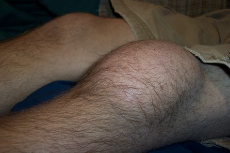 Prepatellar Bursitis Symptoms The most common symptom of prepatellar bursitis is swelling at the kneecap. When bursitis is caused by a trauma to the knee, swelling and other symptoms may appear within 24 hours, similar to a bruise. When bursitis is caused by mini-traumas, such as repeated kneeling, symptoms may appear more slowly, over several days or weeks. Are you seeing or feeling these symptoms? Contact us for an appointment at 248-377-8000 or visit our website http://centerforao.com/knee/. Knee Swelling, Castor Plant, Common Knee Injuries, Knee Anatomy, Castor Bean Plant, Labor Induction, Patellofemoral Pain Syndrome, Castor Bean, Knee Ligaments