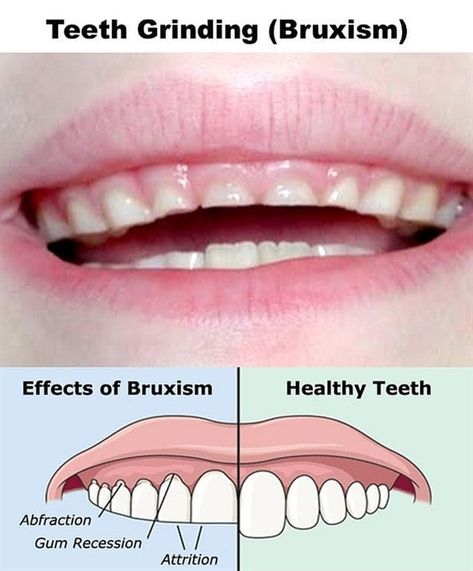 Dentaltown - Patient Education Ideas Dental Education, Dental Posts, Gum Recession, Teeth Grinding, Loose Tooth, Pediatric Dental, Tooth Pain, Periodontal Disease, Grinding Teeth