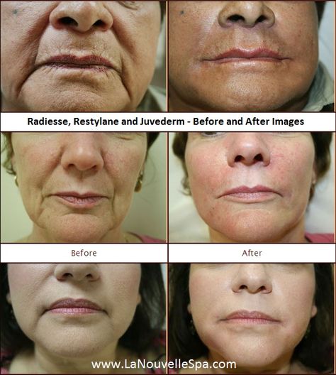 #Radiesse, #Restylane and #Juvederm - Before and After Images by La Nouvelle Medical Spa Rf Before And After Pictures, Radiesse Before After, Face Rejuvenation, Before And After Lip Flip, Before And After Jaw Filler, Juvederm Before And After, Rejuveniqe Oil Before And After, Medical Spa, Spa