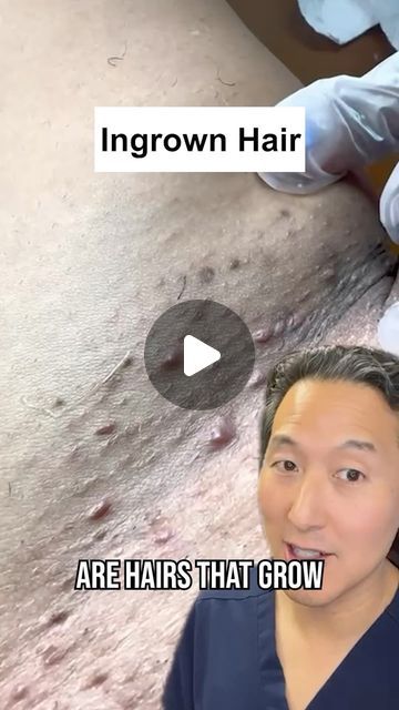 Anthony Youn, MD, FACS on Instagram: "Ingrown or unwanted hairs? I highly recommend Ulike Air 10! It’s the best IPL hair removal device on the market today! 
.
Use the code DrYoun130 to save $130 off on this incredible at home IPL device. Code is good on the Ulike Website.
.
@ulikeglobal #ulikepartner #ulikehairremoval" Ingrown Hair Removal, Hair Removal Device, Ipl Hair Removal, Unwanted Hair, Ingrown Hair, Hair Removal, Sephora, The Incredibles, Coding