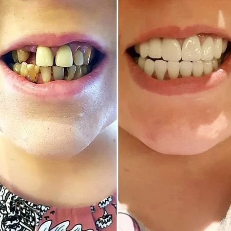 Woman shares photo of $5k teeth transformation done in Bali on Facebook Insane Smile, Teeth Transformation, How To Use Foundation, Smile Tips, Beauty Blender How To Use, Beauty Room Vanity, Teeth Dentist, Cat Exercise, Black Bean Veggie Burger