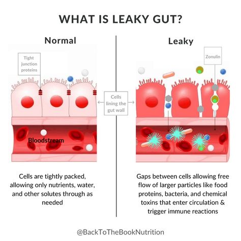 Everything you need to know about Leaky Gut - what causes it, how to know if you have it, and how to fix it naturally! #leakygut #guthealth #healthygut | Back To The Book Nutrition Leaky Gut Symptoms, Yeast Overgrowth, Digestive Juice, Cell Line, Healthy Bacteria, Gut Bacteria, Stomach Acid, Leaky Gut, Chronic Fatigue