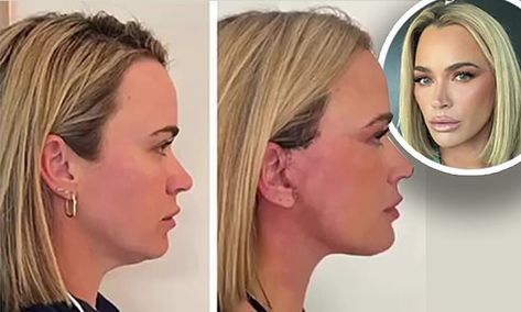 Teddi Mellencamp, 40, shares before and after photos of her neck lift Teddy Mellencamp, Neck Lift Before And After, Lower Face Lift Before And After, Lower Face Lift, Teddi Mellencamp, Chiseled Jaw, Shoulder Length Blonde, Face Lift Surgery, Neck Lift