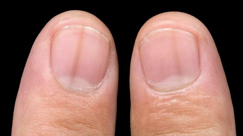 Nail Discoloration, Nail Room Ideas, Nail Infection, Shoe Nails, Nail Room, Lines On Nails, Brittle Nails, Striped Nails, Brown Line