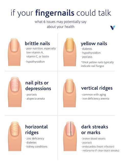 What Your Fingernails Say About Your Health | What's Good by V Fingernail Health, Matcha Benefits, Poor Nutrition, Health Signs, Brittle Nails, Nail Fungus, Nail Health, Yellow Nails, Healthy Nails