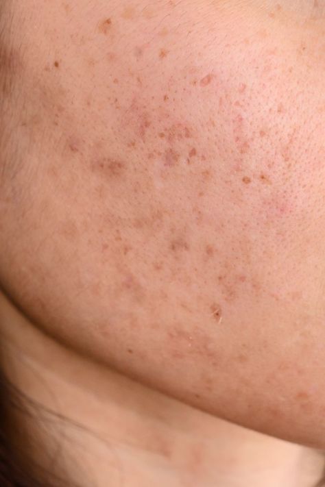 Many people struggle with acne, but it's what comes after the acne that can be confusing. Is it hyperpigmentation or acne scar? This article will help you know the difference. #skincare Best Cough Remedy, Chesty Cough, Post Inflammatory Hyperpigmentation, Acne Scar, Skin Natural Remedies, Cold Sores Remedies, Natural Cold Remedies, Cold Home Remedies, Natural Cough Remedies