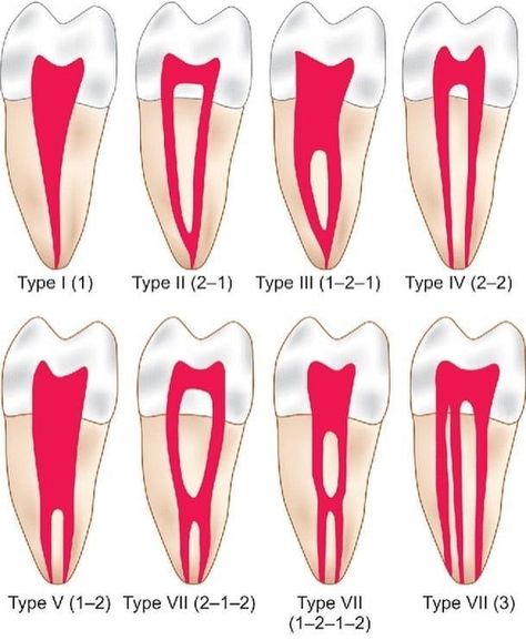 Diagrammatic representations of Vertucci's classification for root canal morphology Dental Art, Dental Student, Root Canal, Instagram Profile, On Instagram, Instagram