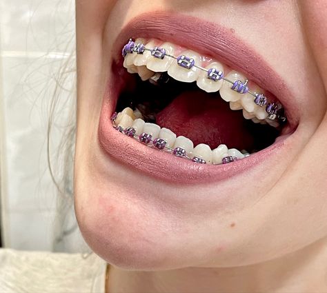 Purple colour has several benefits when it comes on braces. Teeth seem whiter and stainless. Aesthetic Teeth, Dental Braces Colors, Braces Colors Combinations, Pink Braces, Braces Bands, Ceramic Braces, Cute Braces Colors, Braces Cost, Pretty Teeth