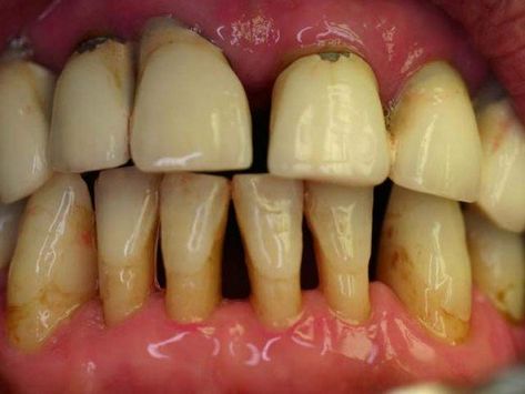 Curing Tooth Decay & Periodontal Disease | HubPages Baby Tooth Decay, Teeth Remedies, Dental Decay, Tooth Decay Remedies, Heal Cavities, Dental Cavities, Teeth Health, Tooth Pain, Periodontal Disease