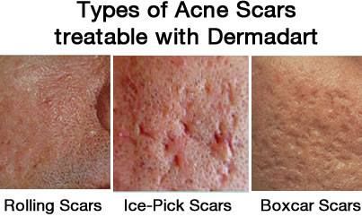 Dermadart can treat rolling, ice-pick and boxcar acne scarring. Acne Scar Remedies, Scar Remedies, Derma Rolling, Facial Scars, Acne Scarring, Acid Peel, Ice Pick, Facial Aesthetics, Types Of Acne