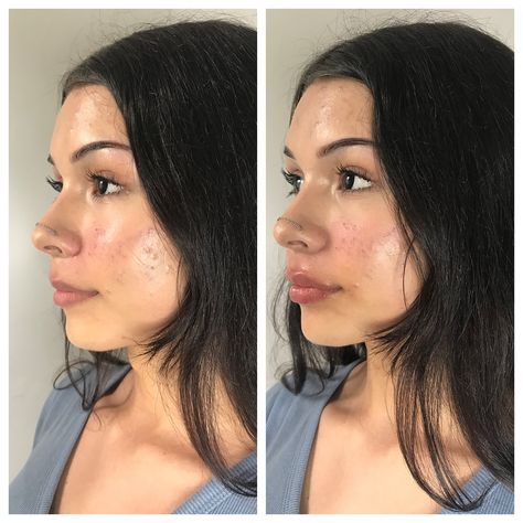 Sharing our favorite transformations from September🌟 Each one represents a boost of confidence and a well-deserved moment of self-care. Treat yourself to a little glow and discover how a fresh look can make all the difference✨ (Slide 2: Lip Filler, Slide 3: Chin Filler, Slide 4: Brow Lamination & Tint, Slide 5: Lip Flip, Slide 6: Sculptra, Slide 7: Brow Lamination and Tint, Slide 8: Tox, Slide 9: DAO Tox, Slide 10: Brow Lamination and Tint) #nashvillemedspa #nashvillewellness #medspanashvil... Half Syringe Lip Filler, Lip Lift Before And After, Brow Lamination And Tint, Lip Flip, Chin Filler, Brow Filler, Lip Filler, Lip Enhancement, Brow Lamination