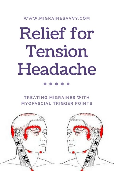 It might just be that myofascial trigger points hold the solution for reducing your migraine pain or tension headaches. It is well worth experimenting with, don't you think? Come see the points you need to work on at www.MigraineSavvy.com Tension Headache Remedies, Tension Migraine, Tension Headache Relief, Natural Migraine Relief, Headache Relief Instant, Migraine Pain, Migraine Prevention, Headache Prevention, Natural Headache Remedies