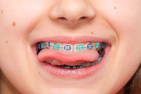 Ultimate Guide to Braces for Kids - Best Dental Care for Kids Colored Braces, Tooth Aesthetic, Braces For Kids, Braces Colours, Lingual Braces, Ceramic Braces, Braces Cost, Dental Care For Kids, Types Of Braces