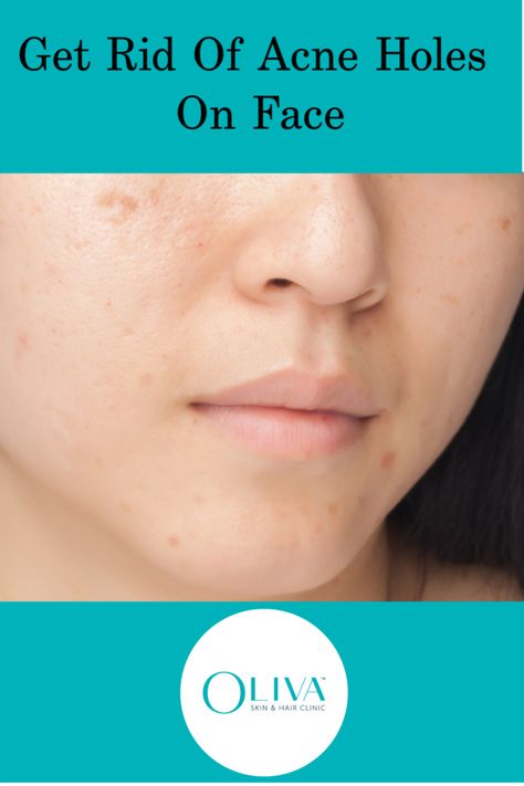 How To Remove Holes In Face, How To Get Rid Of Holes In Face, Acne Holes, Treatments For Acne, Pimple Solution, Pimple Causes, Face Types, Skin And Hair Clinic, Medical Procedures