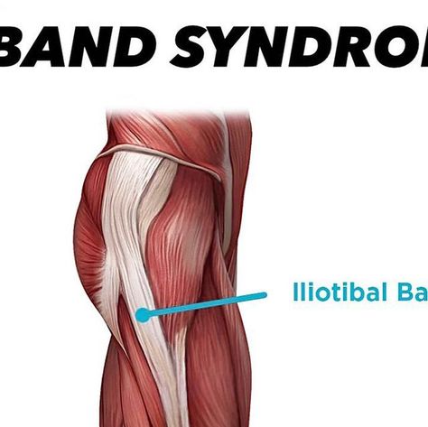 Dr. Tom Walters, DPT, OCS on Instagram: "💥𝐈𝐓 𝐁𝐚𝐧𝐝 𝐒𝐲𝐧𝐝𝐫𝐨𝐦𝐞💥 —— 🔎The IT band (ITB) is a dense, fibrous band of connective tissue that runs along the lateral thigh from the hip to the knee. ITB syndrome typically manifests as lateral knee pain (see image) and is one of the most common overuse injuries occurring in 12-25% of runners and 12.5% of cyclists. - 🧠While stretching may help temporarily reduce pain in some people, research suggests that affected individuals should focus o Knee Pain Exercises, It Band, Connective Tissue, Knee Pain, Stretching, Band, On Instagram, Instagram