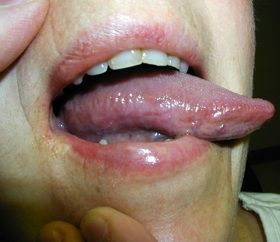 Sore Mouth And Tongue, Burning Tongue, Tongue Sores, Remedies For Dry Mouth, Home Remedies For Allergies, Home Remedies For Warts, Warts Remedy, Natural Remedies For Migraines, Sjogrens Syndrome