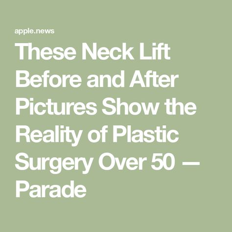 These Neck Lift Before and After Pictures Show the Reality of Plastic Surgery Over 50 — Parade Neck Lift Before And After, Plastic Surgery Before And After, Body Lift Surgery, Neck Lift Surgery, Face Lift Surgery, Neck Lift, After Pictures, Face Lift, Before And After Pictures