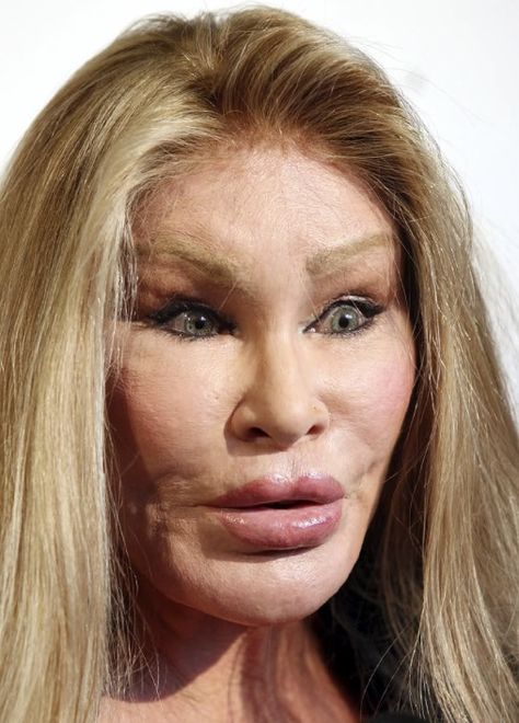 🙀 Botox Forehead, Botched Plastic Surgery, Bad Plastic Surgeries, Plastic Surgery Fail, Plastic Surgery Photos, Plastic Surgery Gone Wrong, Facial Bones, Celebrity Plastic Surgery, Gone Wrong