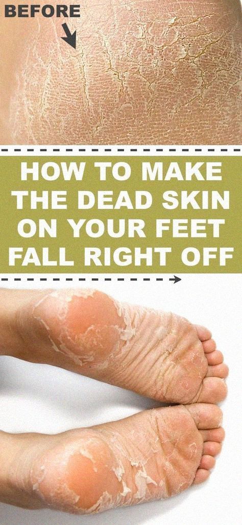 This foot soak makes your feet shed it’s skin like a snake on steroids. Kinda gross, but effective! Soft Feet Remedy, Diy Foot Soak, Dry Cracked Heels, Exfoliating Mask, Callus Remover, Foot Soak, Cracked Heels, Callus Removal, Detox Your Body