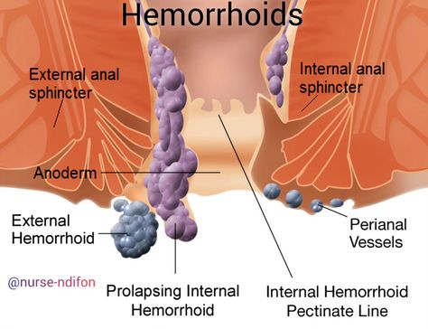 Hemorrhoids, also known as piles, are swollen and inflamed veins in the rectum or anus. They can be internal, located inside the rectum, or external, forming under the skin around the anus. Hemorrhoids often develop due to increased pressure in the rectal area, which can be caused by factors such as straining during bowel movements, sitting for long periods, chronic constipation or diarrhea, obesity, pregnancy, or aging. Types of Hemorrhoids: Internal Hemorrhoids: These develop inside the r... Chronic Constipation, Regular Bowel Movements, Bowel Movement, Under The Skin, Long Periods, Daily Habits, Lifestyle Changes, Regular Exercise, Digestive Health