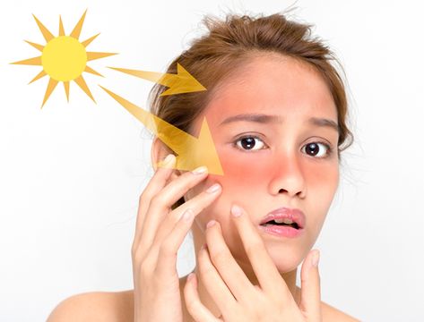 Get Rid Of Tan, Home Remedies For Sunburn, Burn Remedy, Sunburn Remedies, Sunburn Relief, Tan Removal, Suntan Lotion, Protector Solar, Facial Cleansing Brush