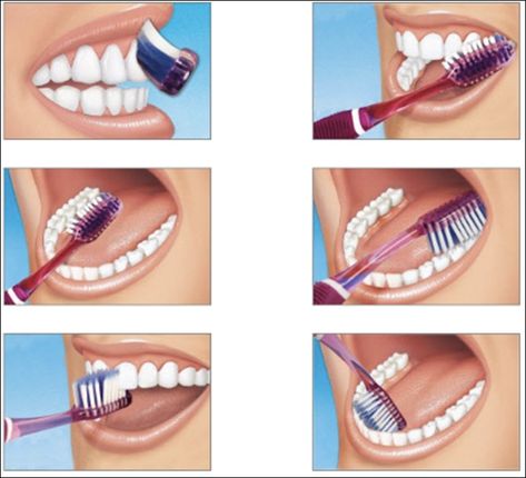 Brushing Technique, Dental Posts, Remedies For Tooth Ache, Dental Posters, Tooth Brushing, Kedokteran Gigi, Sikat Gigi, Dental Life, How To Prevent Cavities