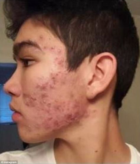 Teenage boy CLEARED severe acne with an $8 moisturizer Budget Skincare, Kids Skin Care, Get Rid Of Acne, Severe Acne, Rid Of Acne, Best Skin Care Routine, Cystic Acne, How To Get Rid Of Acne, Care Routine