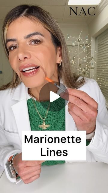 Filler For Marionette Lines, Botox For Marionette Lines, Botox Marionette Lines, Marionette Lines Before And After, Marionette Lines Filler, Wrinkles Around Mouth, Botox Injection Sites, Injection Sites, Botox Injection