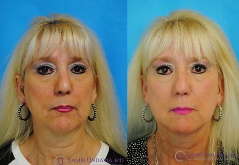 This is a 2 week before and after filler result using 2 syringes of Restylane to improve the wrinkles of the lower third of the face and give her jawline back to her. Lower Third, Lower Thirds, Botox Fillers, Botox Injections, Double Chin, Years Younger, Wrinkles, The Face, Take That