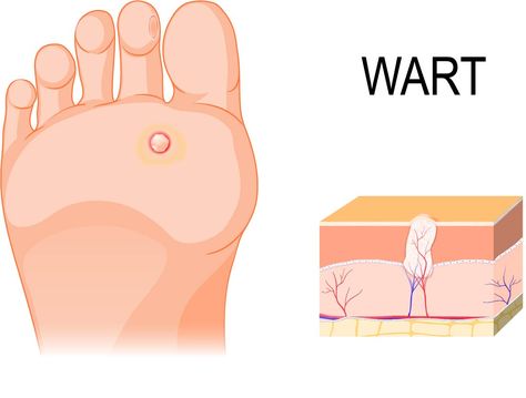 Warts are no fun! Use vinegar to remove them Uses For Apple Cider, Plantar Warts, Strawberry Legs, Get Rid Of Warts, Apple Cider Benefits, Laser Therapy, Tea Tree Essential Oil, Tree Oil, Cider Vinegar