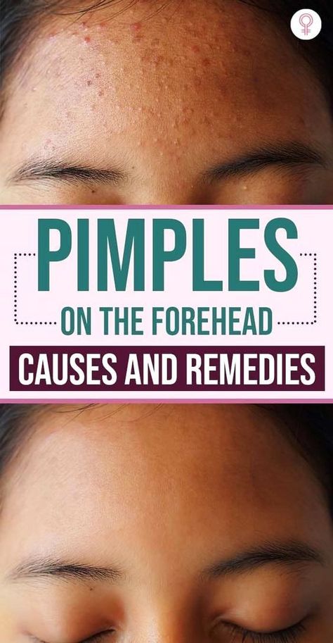 Generated Description with relevant hashtags. Forehead Breakout Remedies, Forehead Acne Remedies, How To Get Rid Of Tiny Bumps On Forehead, How To Get Rid Of Forehead Acne, Honey For Pimples, Pimples On Face Meaning, Forehead Pimples, Forehead Acne Cause, Causes Of Pimples