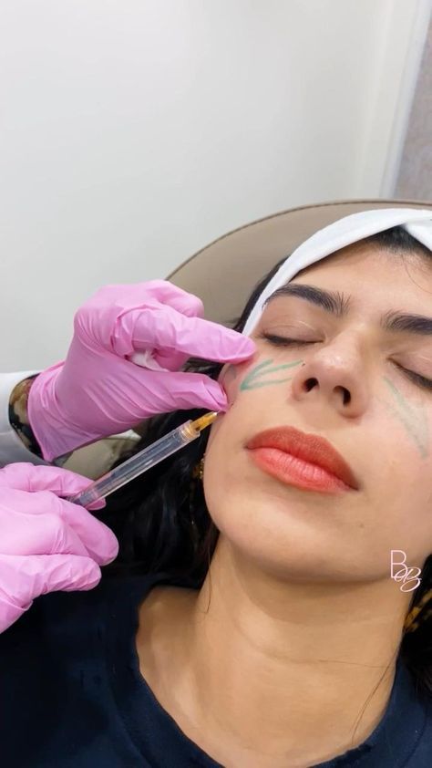 Under Eye Filler, Face Injections, Eye Filler, Dermal Fillers Lips, Facial Injections, Facial Benefits, Cosmetic Fillers, Esthetician Inspiration, Skin Anatomy