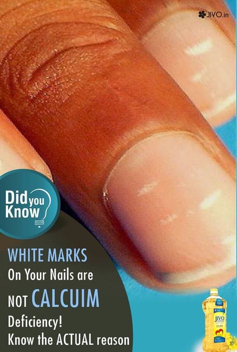 Nail Infection White Marks On Nails, White Spots On Nails, Nail Care Diy, Age Spot Removal, Age Spot, Nail Infection, Spot Remover, Fungal Nail, Nails Today