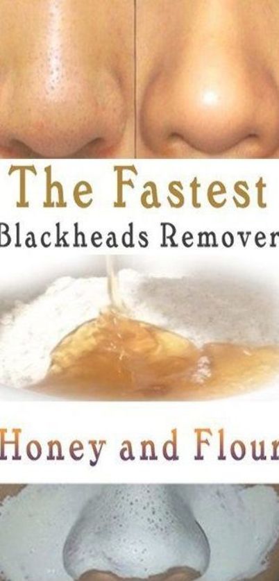 Pimples Overnight, Skin Care Routine For 20s, Black Heads, Homemade Lotion, How To Get Rid Of Pimples, Home Remedies For Hair, Smink Inspiration, Get Rid Of Blackheads, Natural Therapy