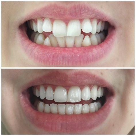 What a beautiful transformation 😃💜 #smilemakeover Sensitive Teeth Remedy, Dental Videos, Heal Cavities, Veneers Teeth, Dental Art, Botox Injections, Dental Crowns, Best Teeth Whitening, Dental Surgery