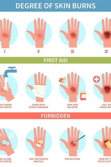 What To Put On Burns On Skin, First Aid Poster, First Aid For Burns, Burn Remedy, Burn Care, Treat Burns, Survival Skills Emergency Preparedness, Medicine Kit, Medical Tips